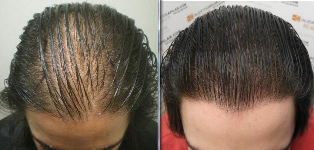 Resultado de imagen para Remedios naturales para la alopecia